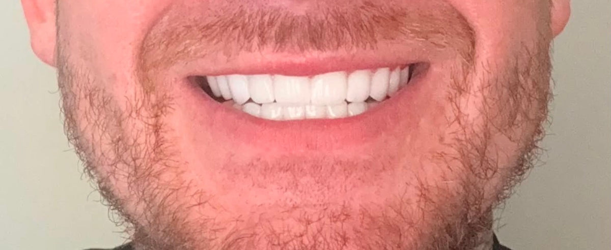 B1 - PROFESSIONAL TEETH WHITENING SYSTEM