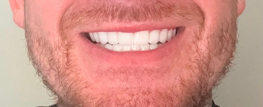 B1 - PROFESSIONAL TEETH WHITENING SYSTEM